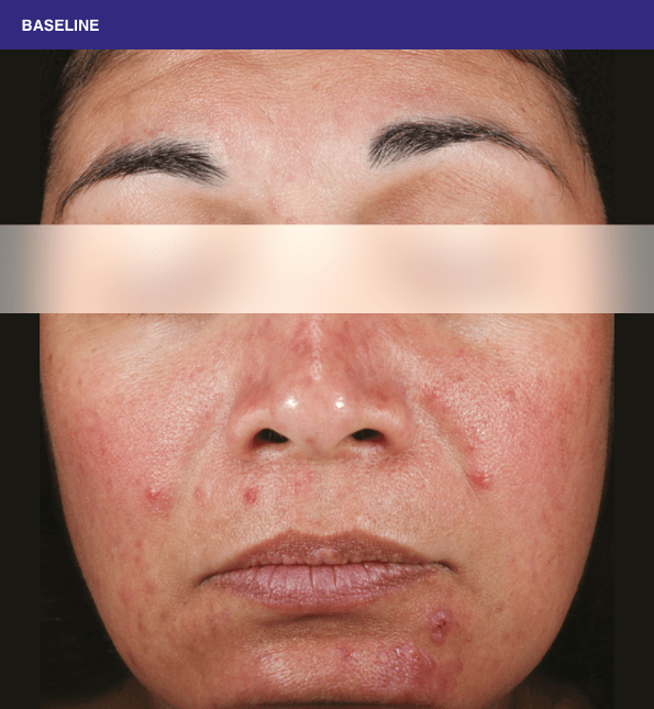 Sliding scale of woman face with lesions of rosacea at baseline to week 16 showing burden of roacea on her cheeks and nose then showing nearly clear skin.