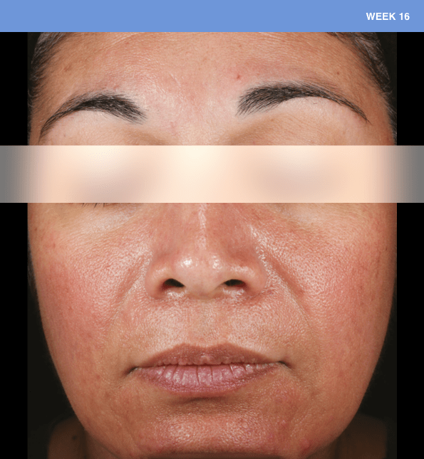 Sliding scale of woman face with lesions of rosacea at baseline to week 16 showing burden of roacea on her cheeks and nose then showing nearly clear skin.