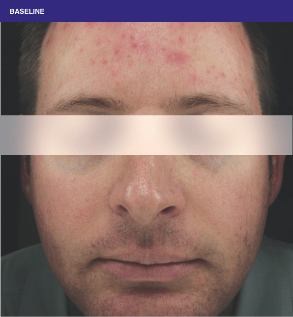 Sliding scale of young man face with lesions of rosacea at baseline to week 16 showing burden of roacea on his cheeks and forehead then showing nearly clear skin.