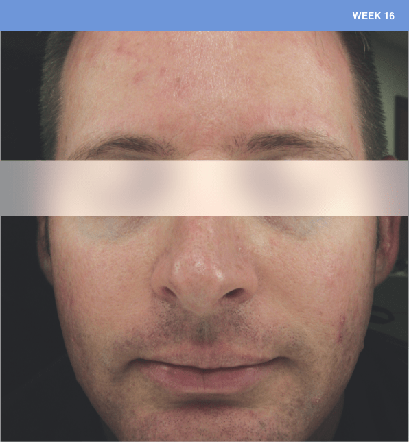 Sliding scale of young man face with lesions of rosacea at baseline to week 16 showing burden of roacea on his cheeks and forehead then showing nearly clear skin.