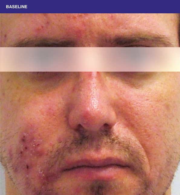 Sliding scale of young man face with lesions of rosacea at baseline to week 16 showing burden of roacea on his cheeks, forehead and nose then showing nearly clear skin.