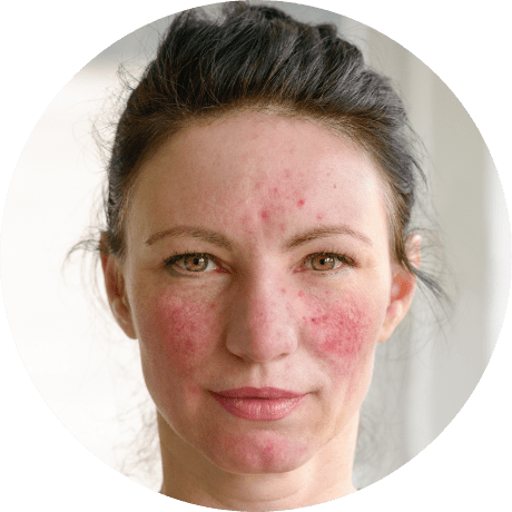 Treatment for rosacea